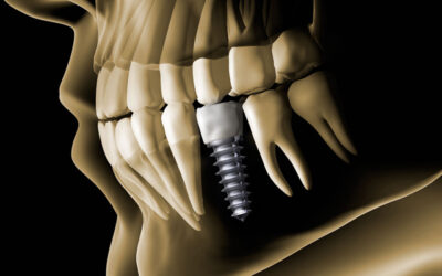 Por qué es importante reponer un diente perdido (aunque no se vea al sonreír)