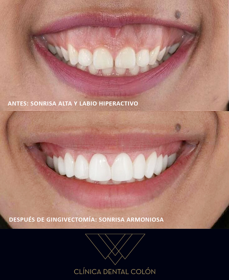 gingivectomia sonrisa alta y labio hiperactivo