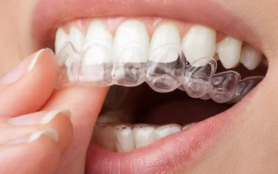 Ortodoncia Invisible en Castellón de la Plana: Mejora tu Sonrisa Sin Esperas y Sin Metales
