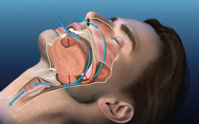 ¿Roncas al dormir? Descubre el tratamiento que puede ayudarte a descansar mejor