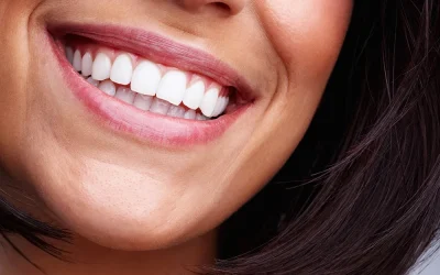 Carillas Dentales en Castellón: Innovación, Precisión y Sonrisas Transformadas