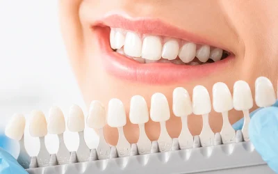 Implantes dentales en Castellón: la solución definitiva para volver a sonreír