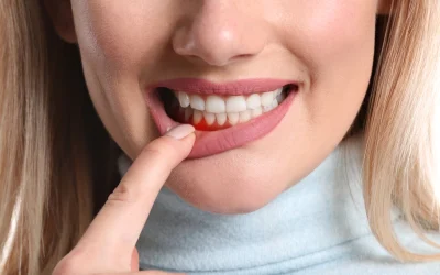 Sangrado de encías y gingivitis en Castellón de la Plana: causas, síntomas y tratamiento